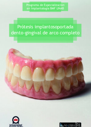 Prótesis implantosoportada dento-gingival de arco completo